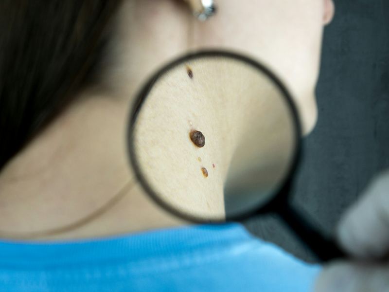 A dermatologist examining skin closely through a magnifying lens